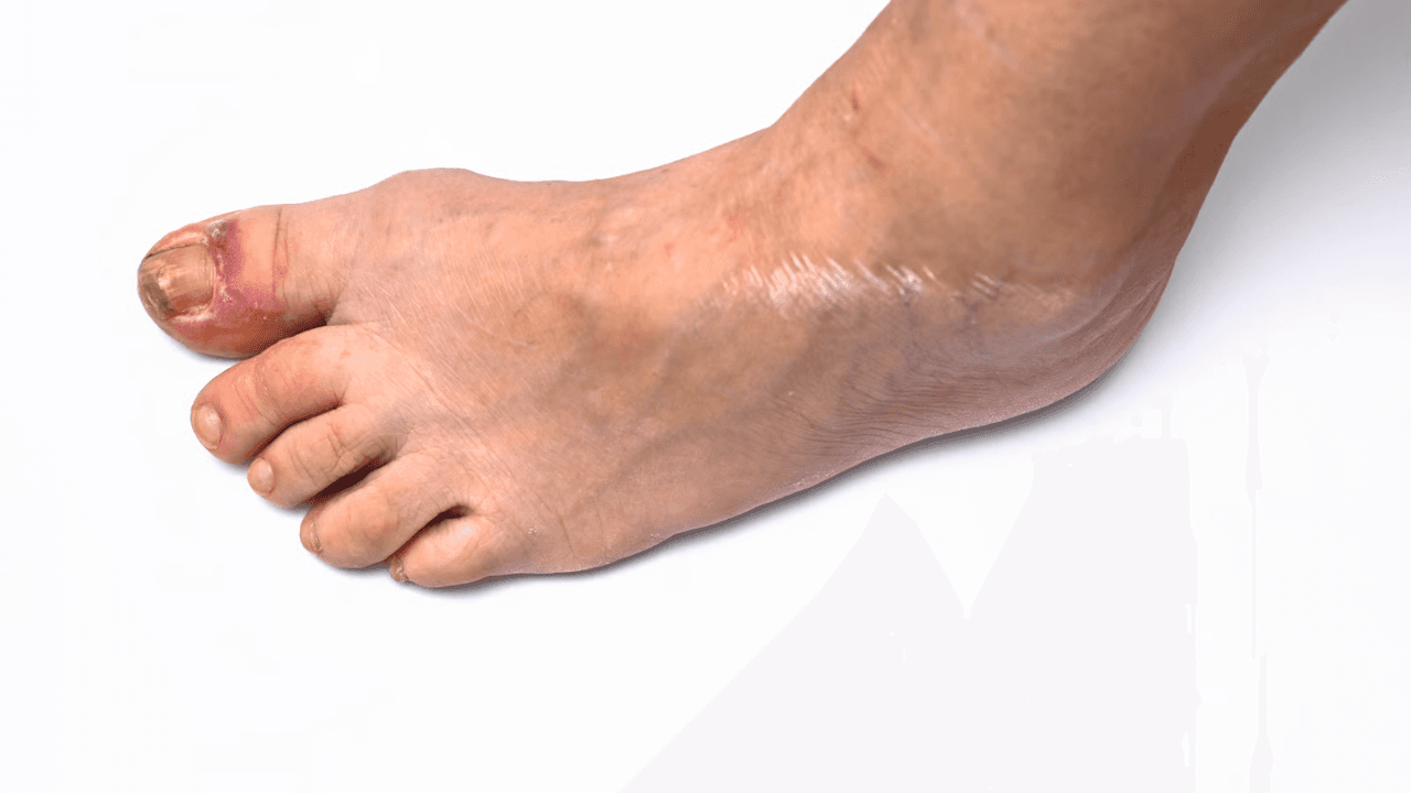 Gangrena en el pie: tipos y causas
